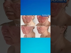 HIFU ou laser CO2, lequel préférez-vous?