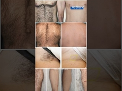 Épilation au laser avant et après