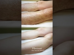 Je vous présente la dernière machine à épilation laser à fibre, Astiland Fibermax!