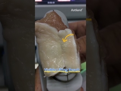 Vérifions l'effet de lifting instantané des HIFU