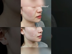 Avez-vous essayé la radiofréquence (RF) + HIFU pour raffermir la peau ? #AntiÂge #LiftingCutané #cliniquebeauté #soindevisage