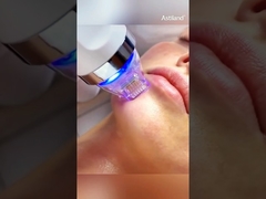 Microneedling RF pour le rajeunissement de la peau #soindelapeau #pourtoi #appareildebeauté #équipementdesalon #peauradiante